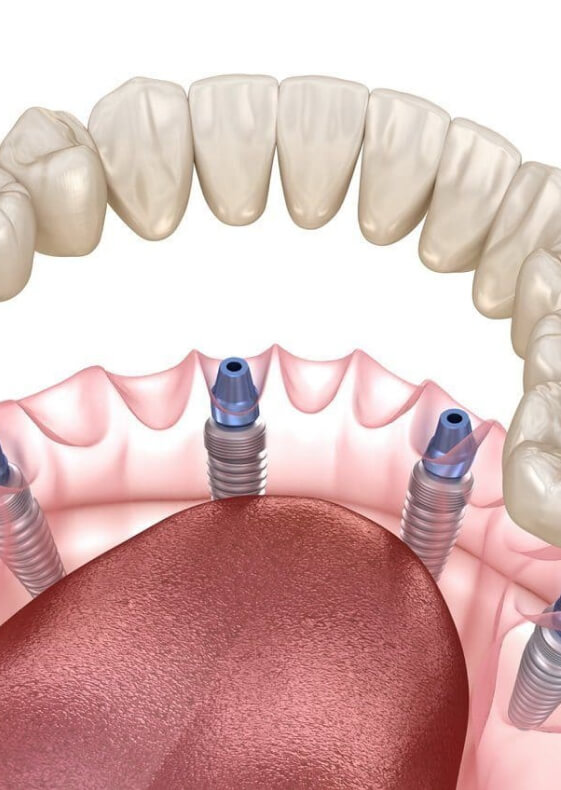 Имплантация «Все на четырех» Straumann Pro Arch