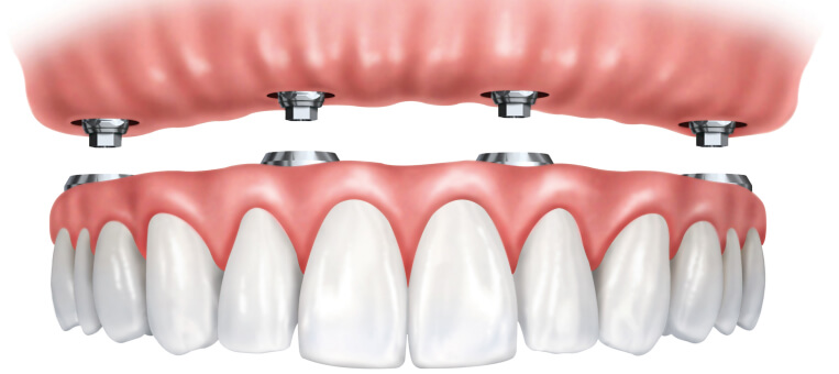Имплантация «Все на четырех» Straumann Pro Arch