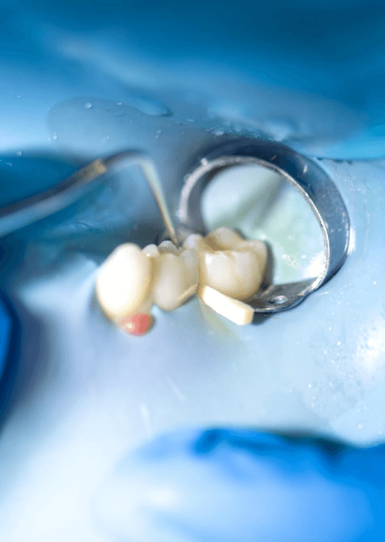 Реставрация зубов у детей